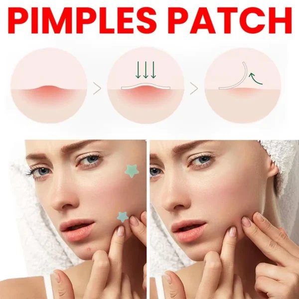 Parche para espinillas de alta gama, parches para acné en forma de corazón/estrella, parches de puntos para acné, hidrata para cubrir las imperfecciones y las imperfecciones 240 Uds. Nuevo - Imagen 3