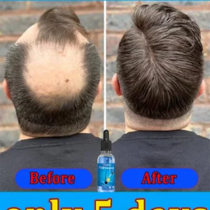 Repara la calvicie y la caída del cabello con aceite esencial, ten un cabello grueso en 7 días, estarás más joven y guapo con el cabello.