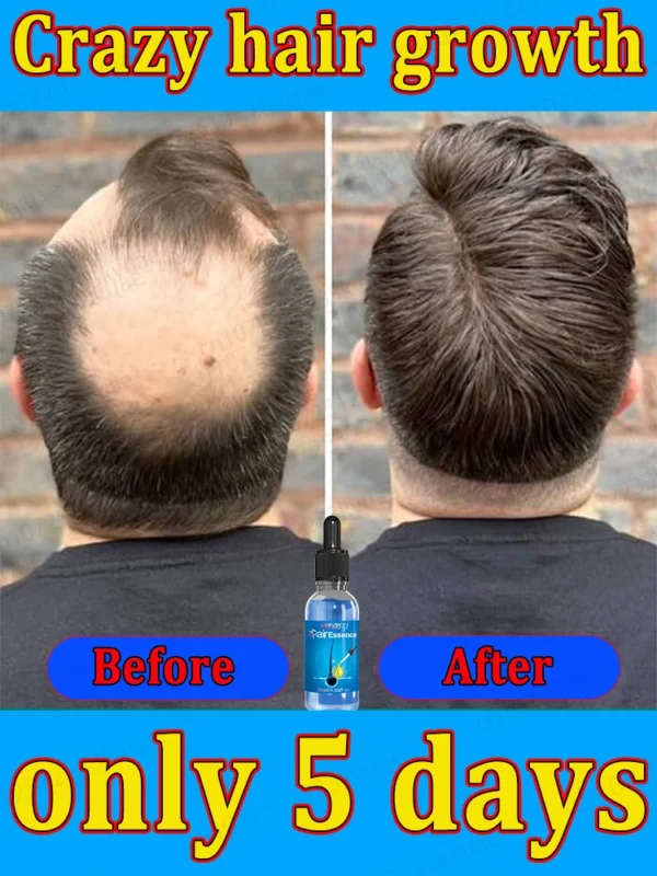 Repara la calvicie y la caída del cabello con aceite esencial, ten un cabello grueso en 7 días, estarás más joven y guapo con el cabello.