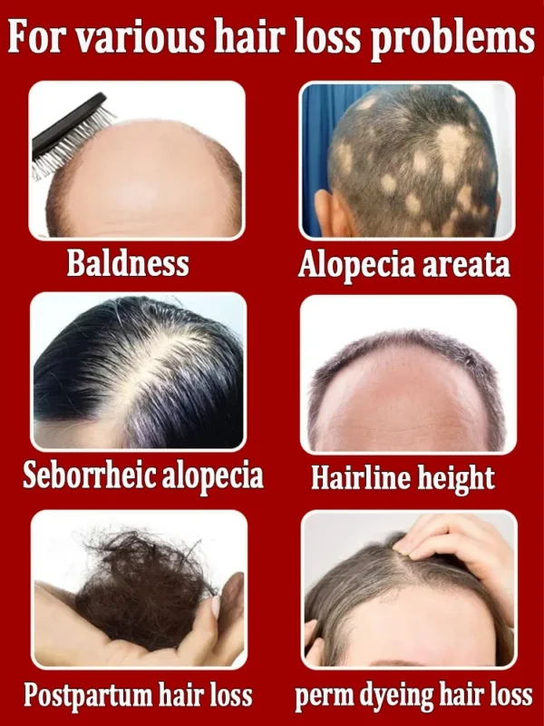 Repara la calvicie y la caída del cabello con aceite esencial, ten un cabello grueso en 7 días, estarás más joven y guapo con el cabello. - Imagen 3